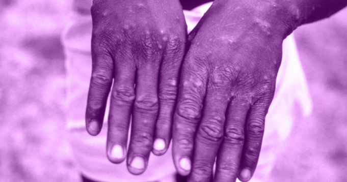 Vaiolo delle scimmie: è emergenza sanitaria. L’Oms fa chiarezza su trasmissione e diffusione Vaiolo